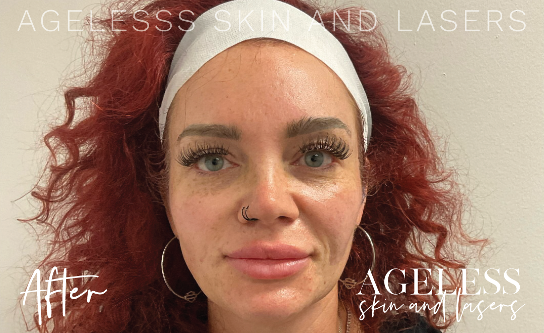 After Image: Sculptra Results, 3 sessions - front