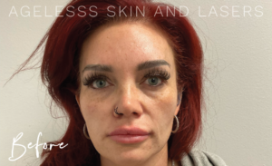 Before Image: Sculptra Results, 3 sessions