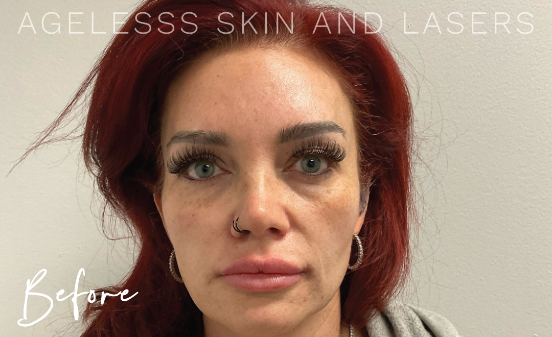 Before Image: Sculptra Results, 3 sessions - front