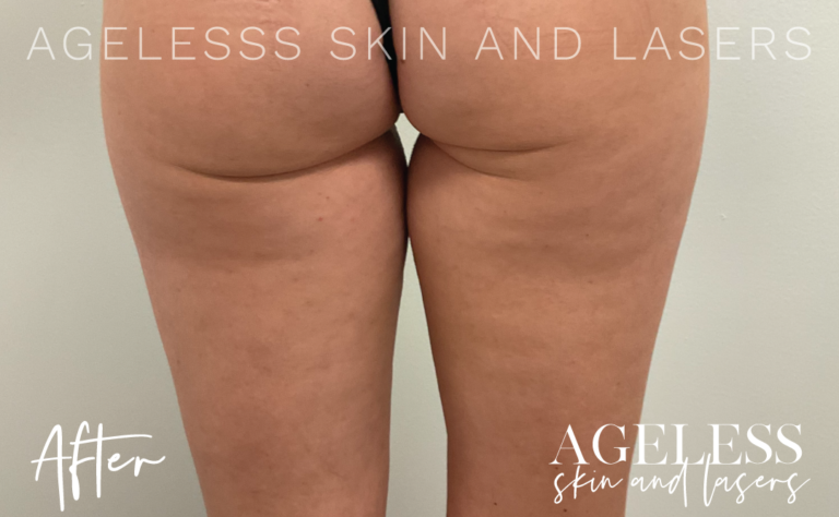 After Image: Sofwave Cellulite Buttocks Results - back