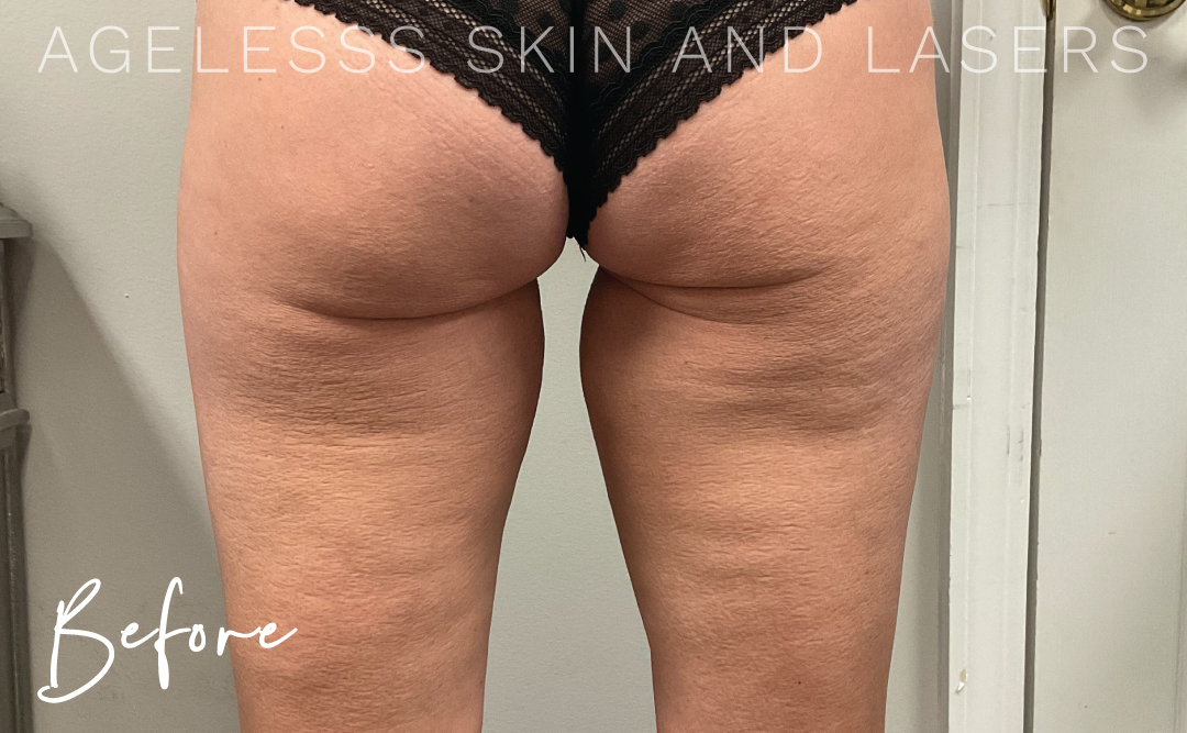 Before Image: Sofwave Cellulite Buttocks Results - back