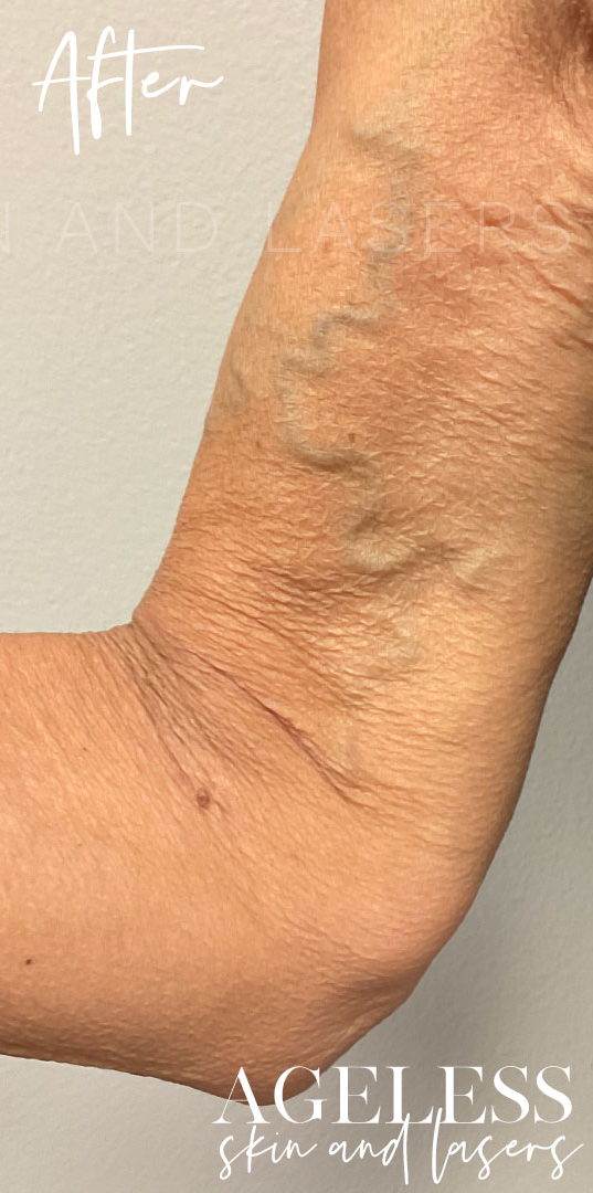 After Image: Sofwave Skin Tightening Results - front