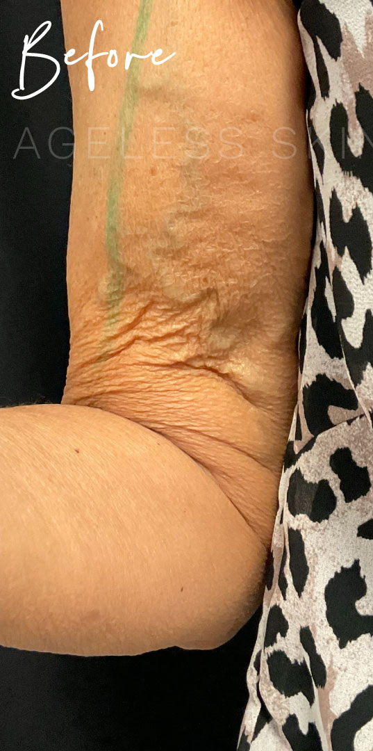 Before Image: Sofwave Skin Tightening Results - front