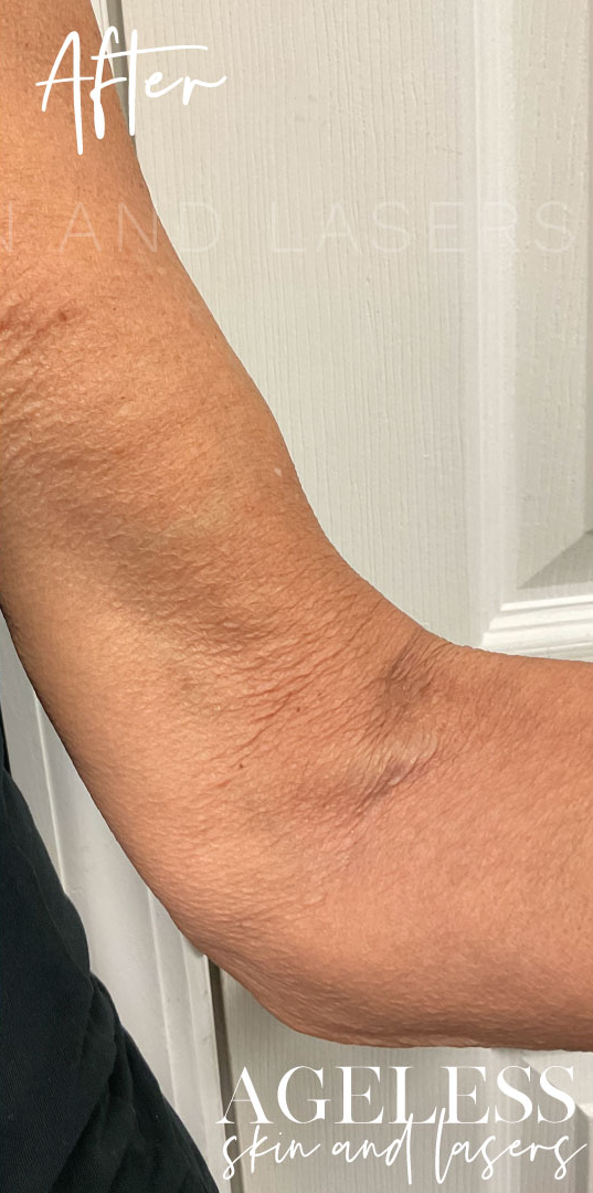 After Image: Sofwave Skin Tightening Results - 