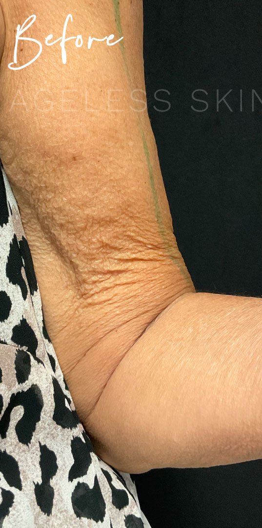 Before Image: Sofwave Skin Tightening Results - 