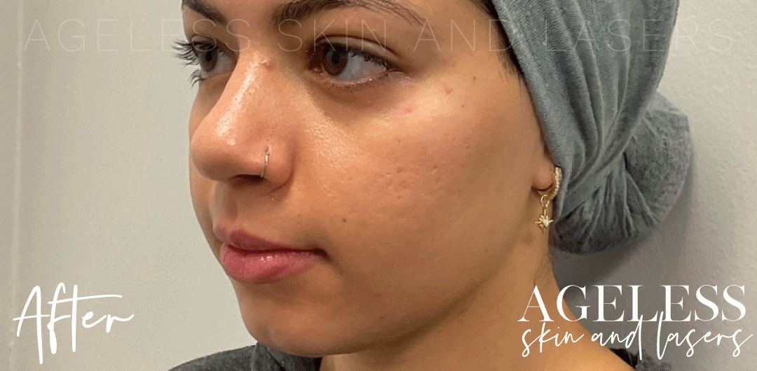 After Image: UltraClear Acne Scarring Results - left-front-oblique