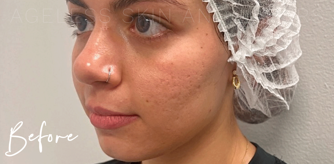 Before Image: UltraClear Acne Scarring Results - left-front-oblique