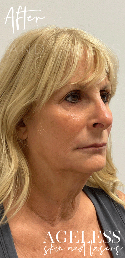 After Image: UltraClear and Coring Resurfacing Results - right-front-oblique
