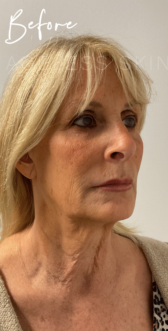 Before Image: UltraClear and Coring Resurfacing Results - right-front-oblique