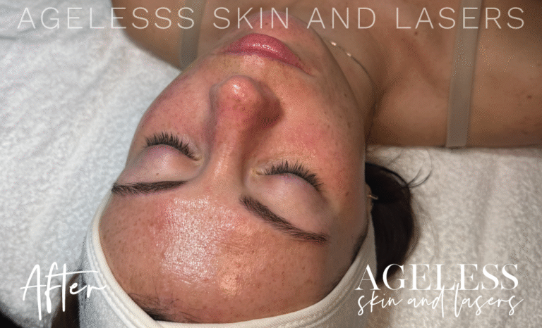 After Image: Hydrafacial - other