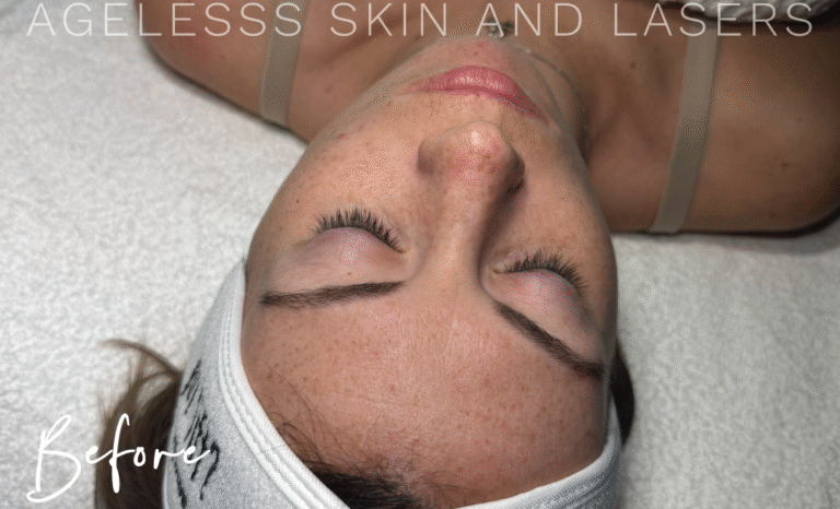 Before Image: Hydrafacial - other
