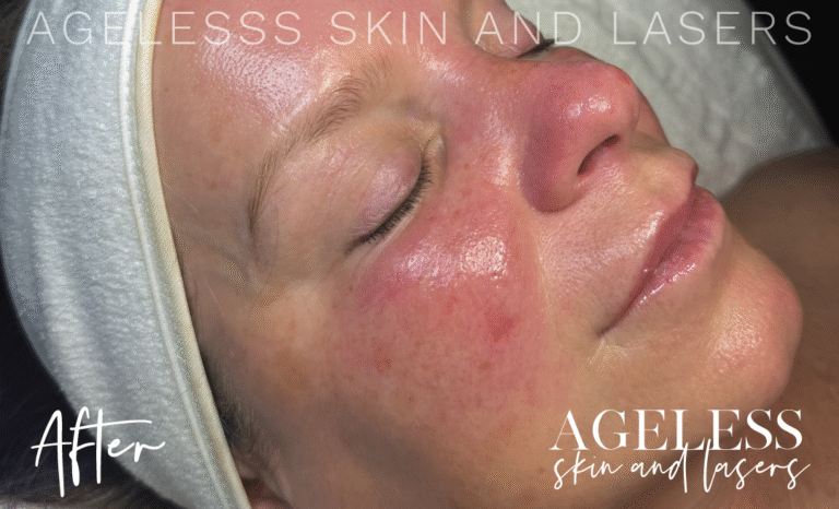 After Image: Hydrafacial - right-front-oblique