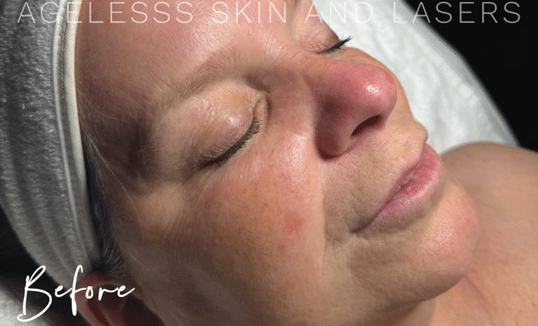 Before Image: Hydrafacial - right-front-oblique