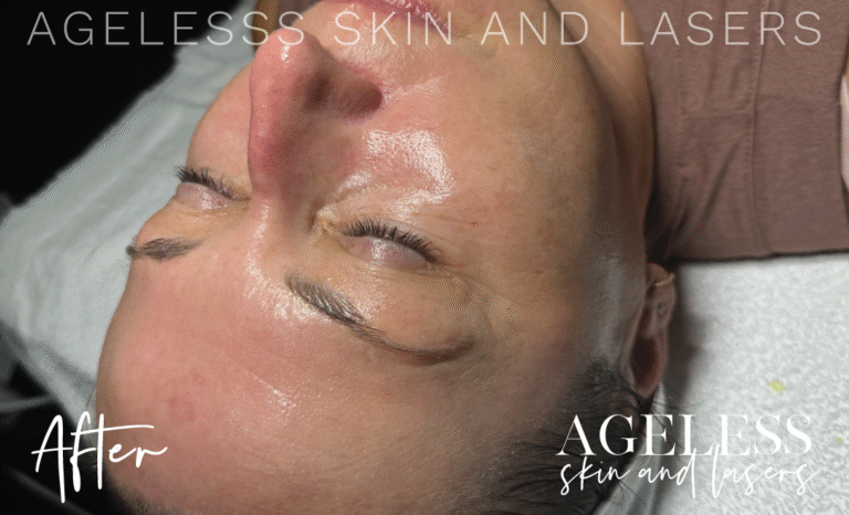 After Image: Hydrafacial - other