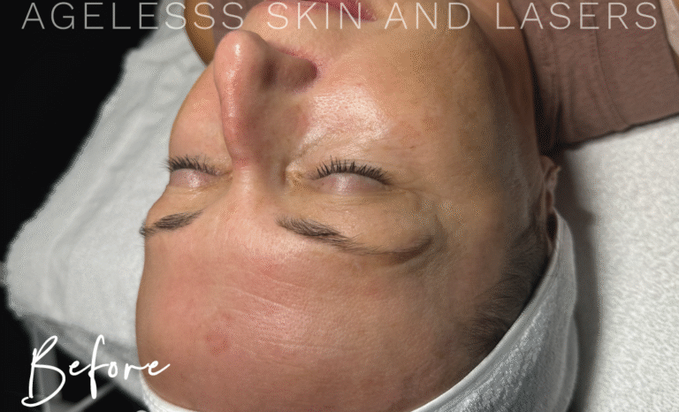 Before Image: Hydrafacial - other
