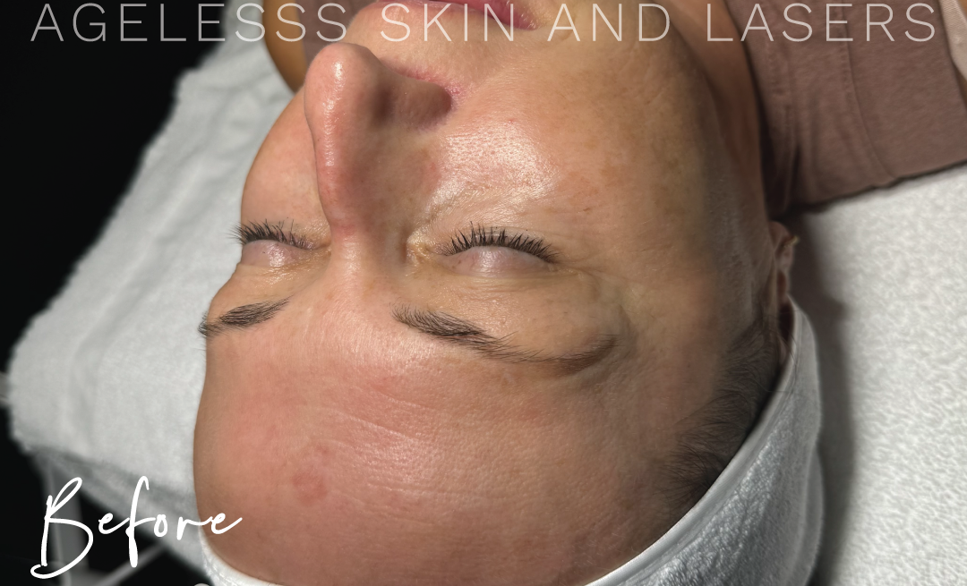 Before Image: Hydrafacial - other
