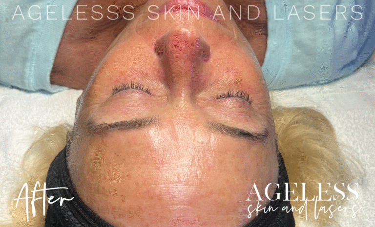 After Image: Hydrafacial - other