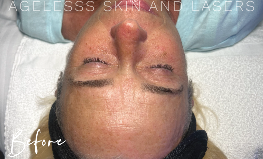 Before Image: Hydrafacial - other