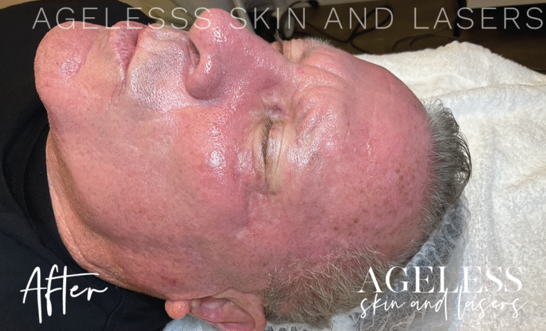 After Image: Hydrafacial - other