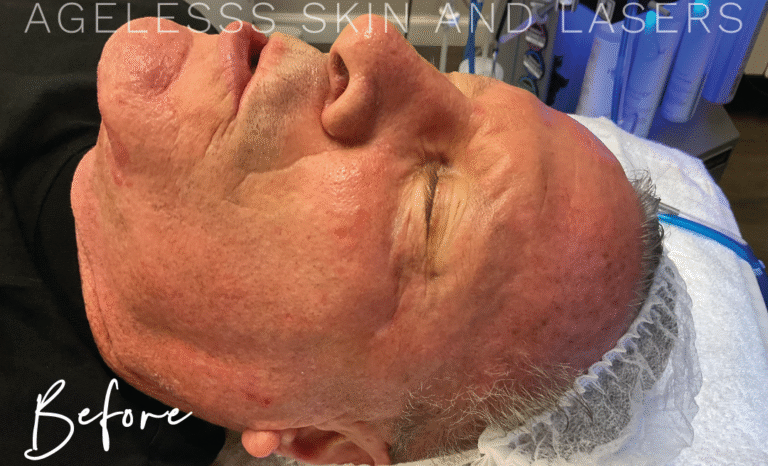 Before Image: Hydrafacial - other