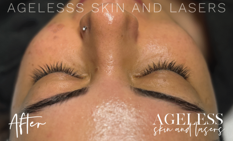 After Image: Hydrafacial - front