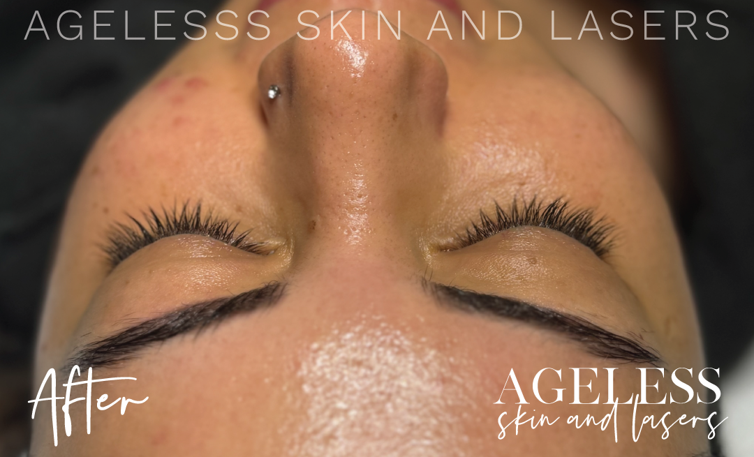 After Image: Hydrafacial - front