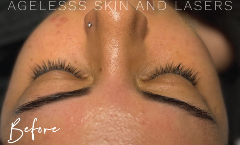 Before Image: Hydrafacial - front