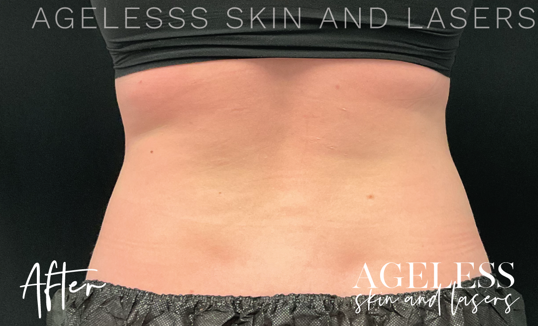 After Image: CoolSculpting - back