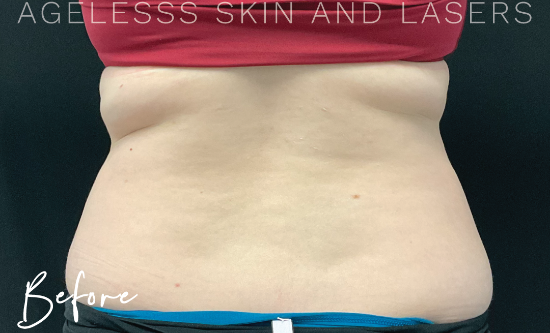 Before Image: CoolSculpting - back