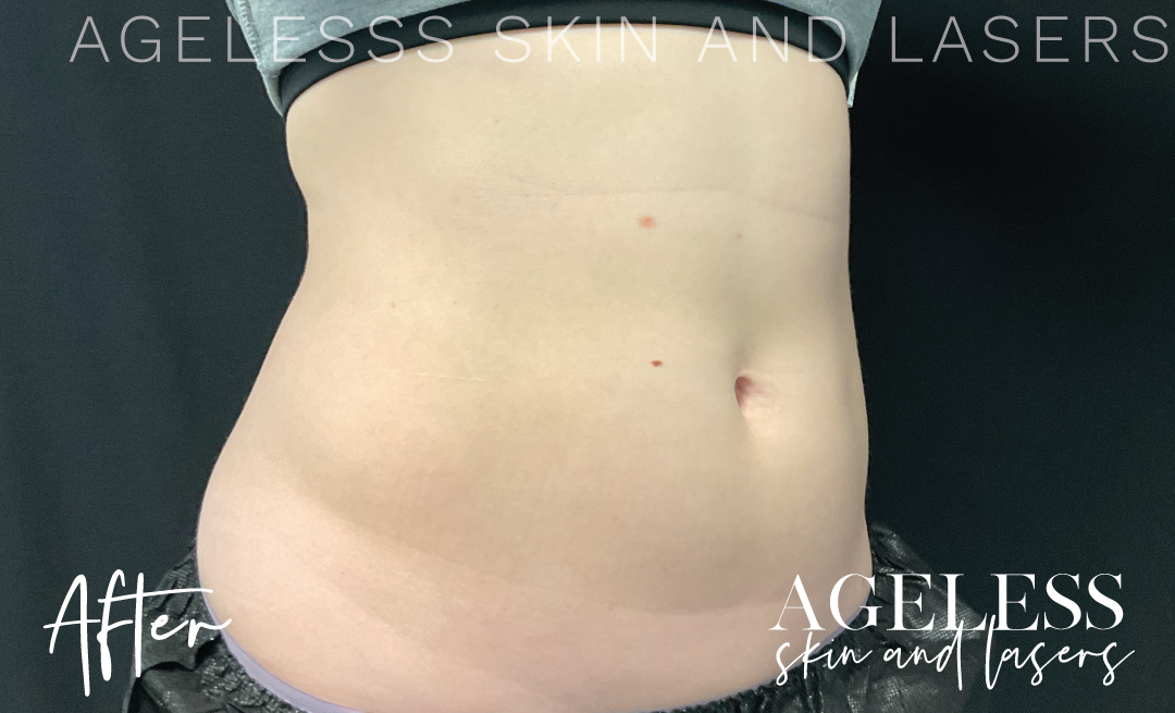 After Image: CoolSculpting - right-front-oblique