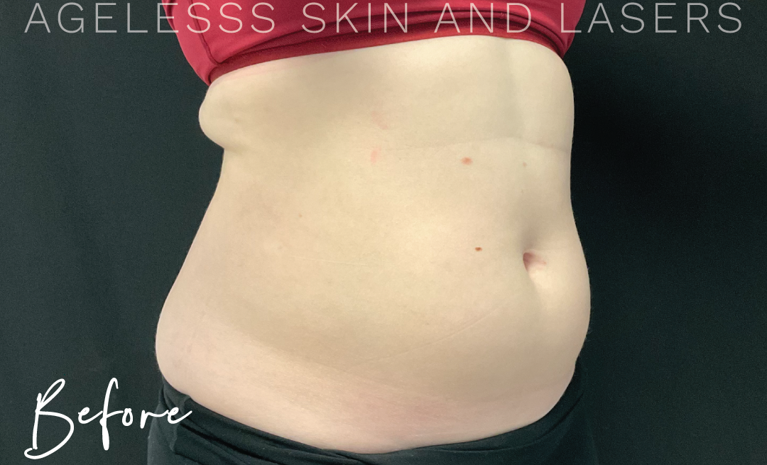 Before Image: CoolSculpting - right-front-oblique