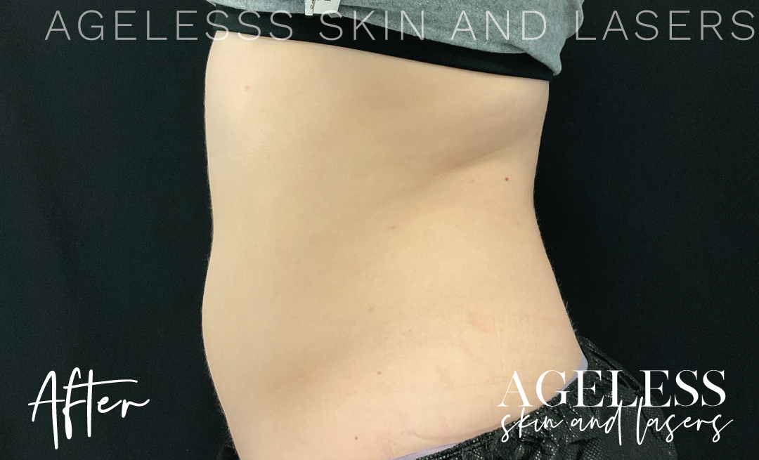 After Image: CoolSculpting - left-side