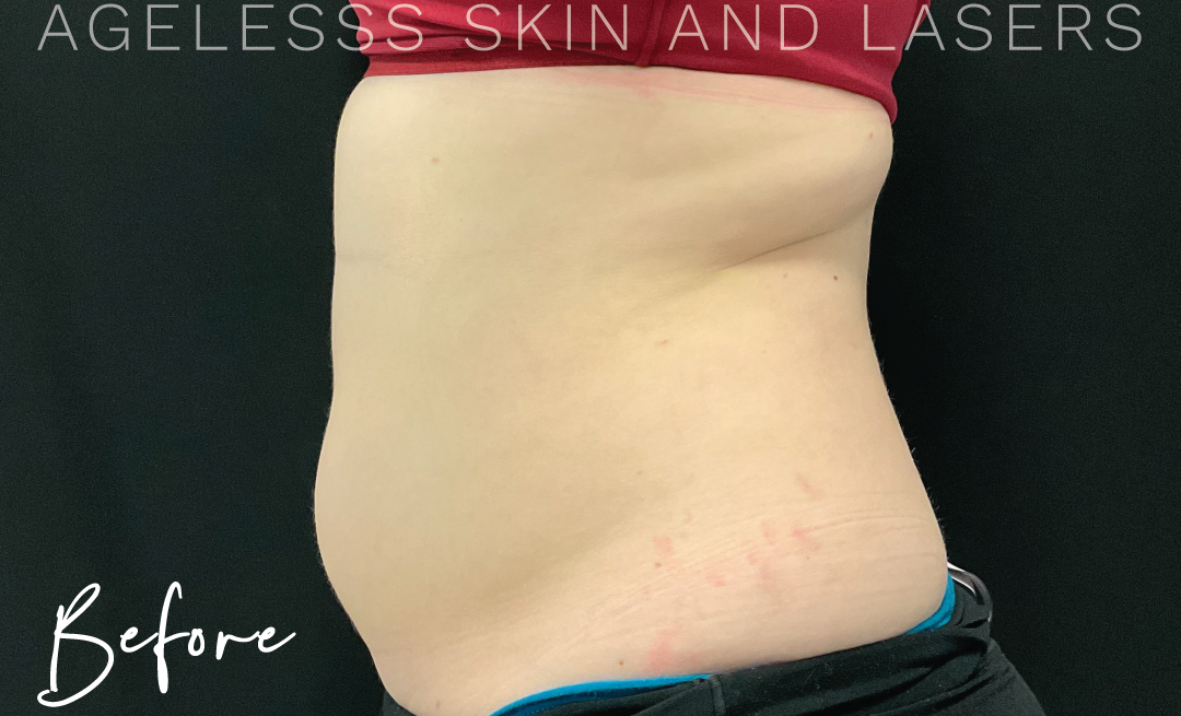 Before Image: CoolSculpting - left-side