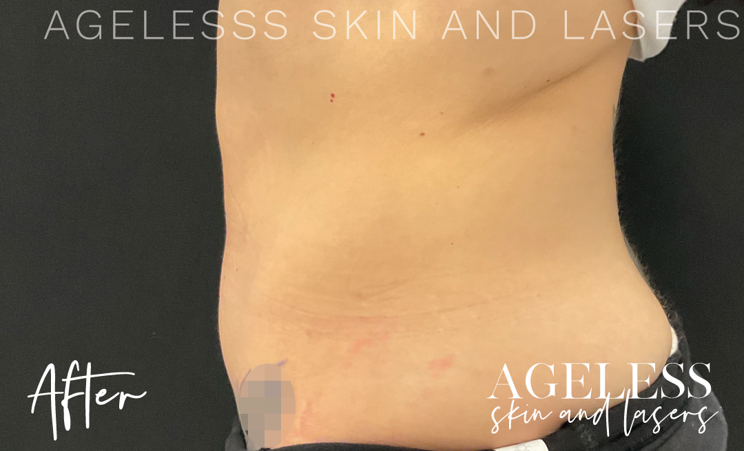 After Image: CoolSculpting - left-side