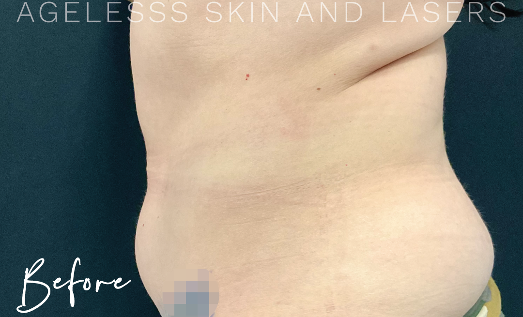 Before Image: CoolSculpting - left-side