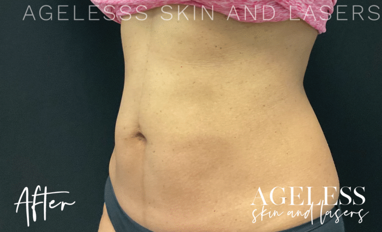 After Image: CoolSculpting - left-front-oblique