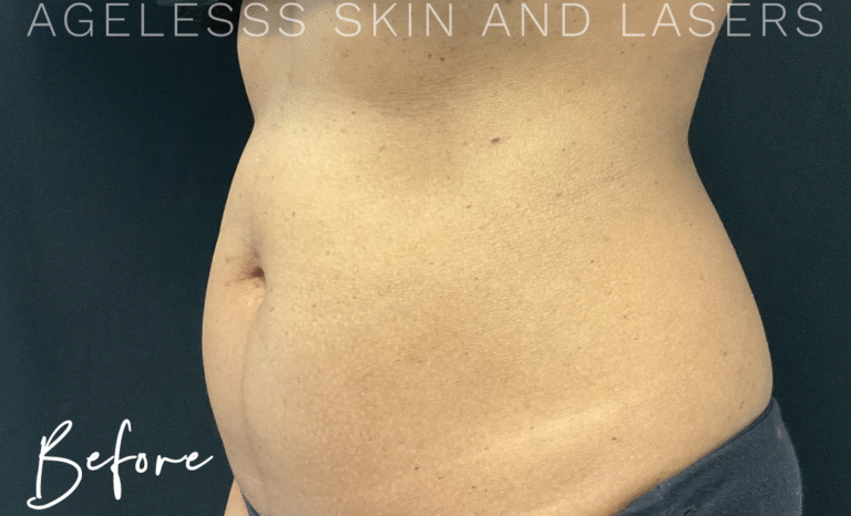 Before Image: CoolSculpting - left-front-oblique