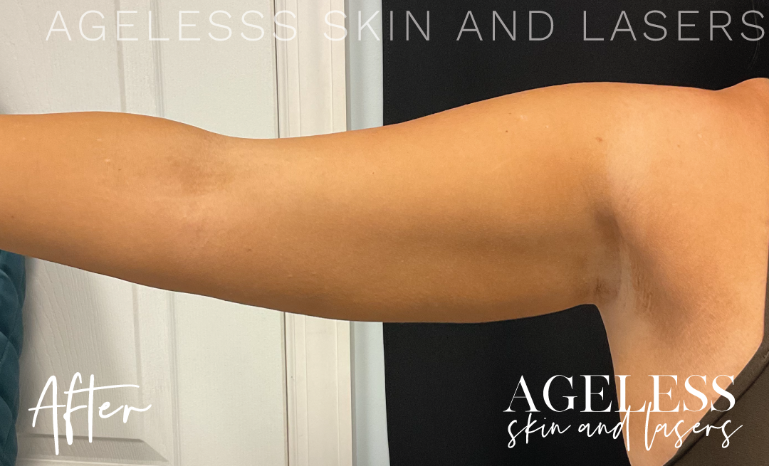 After Image: CoolSculpting - front