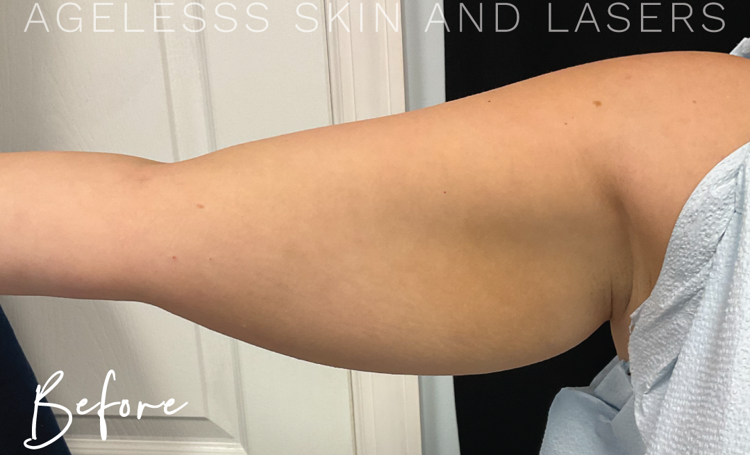 Before Image: CoolSculpting - front