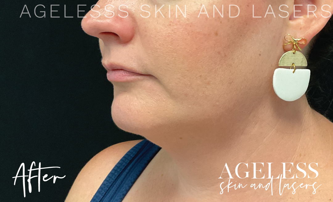 After Image: CoolSculpting - left-front-oblique