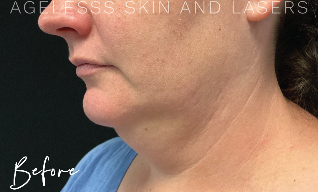 Before Image: CoolSculpting - left-front-oblique