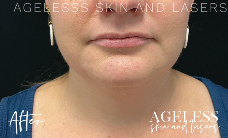 After Image: CoolSculpting - front