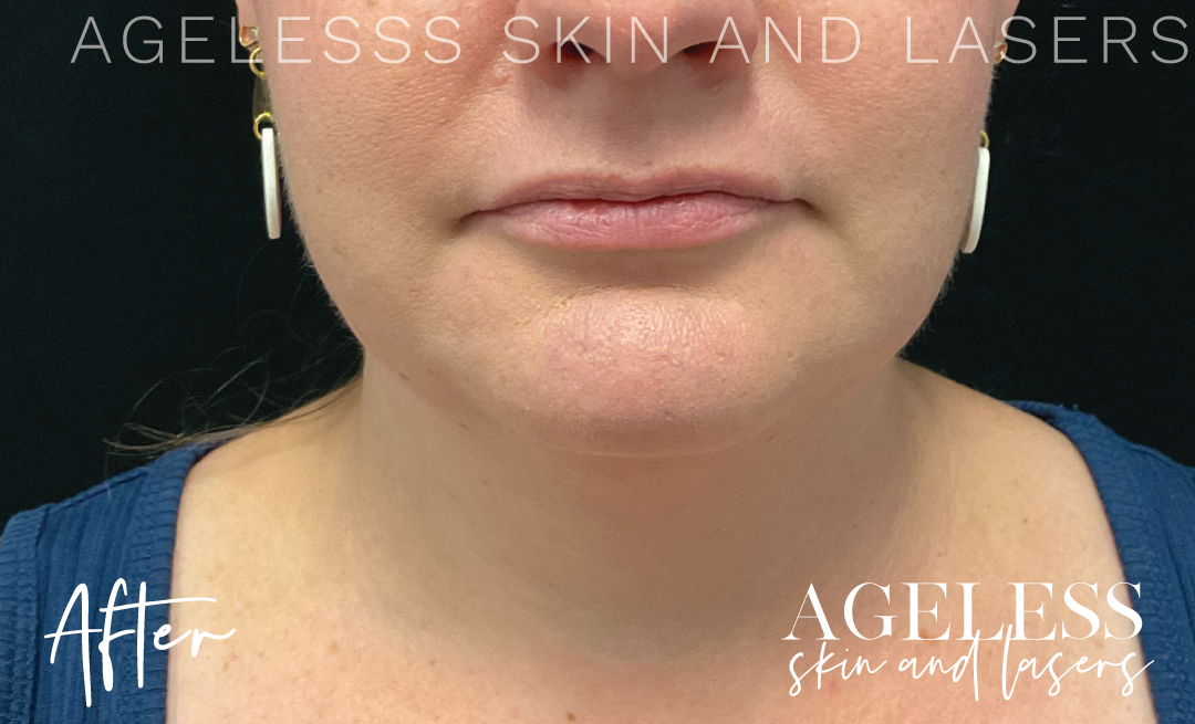 After Image: CoolSculpting - front