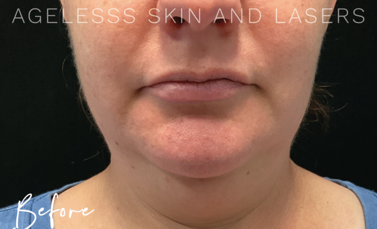 Before Image: CoolSculpting - front