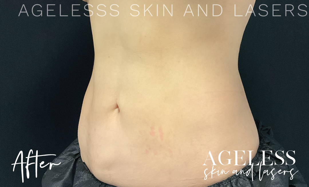 After Image: CoolSculpting - left-front-oblique