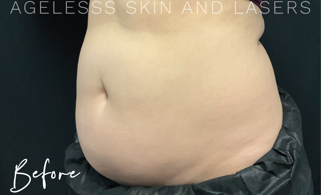 Before Image: CoolSculpting - left-front-oblique