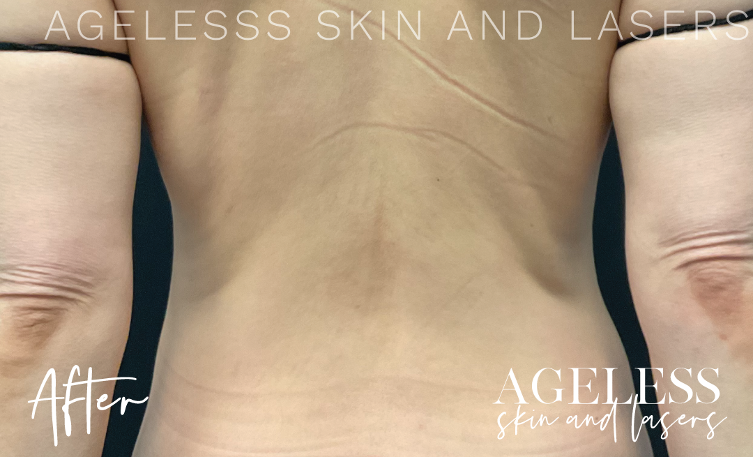 After Image: CoolSculpting - back