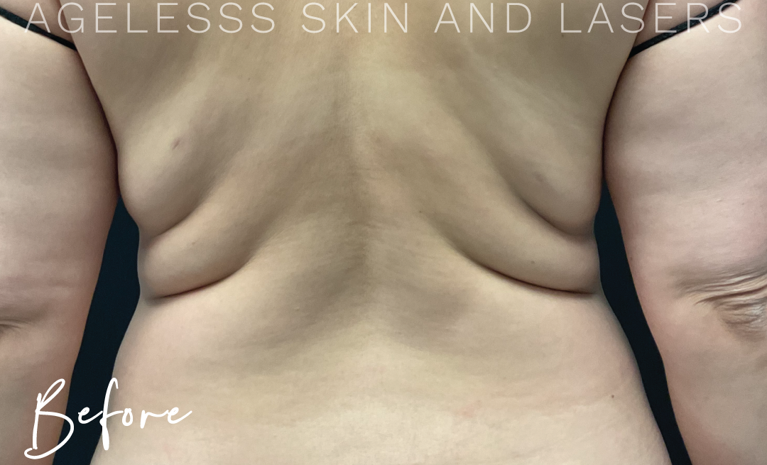 Before Image: CoolSculpting - back