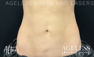 After Image: CoolSculpting
