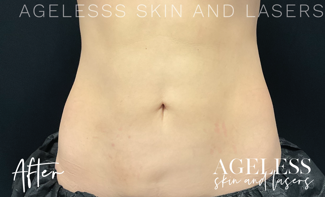 After Image: CoolSculpting - front